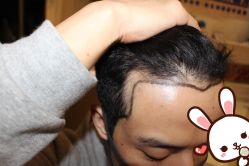 点击看大图 -大麦微针植发丨全国连锁