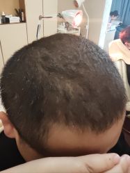 -大麦微针植发丨全国连锁