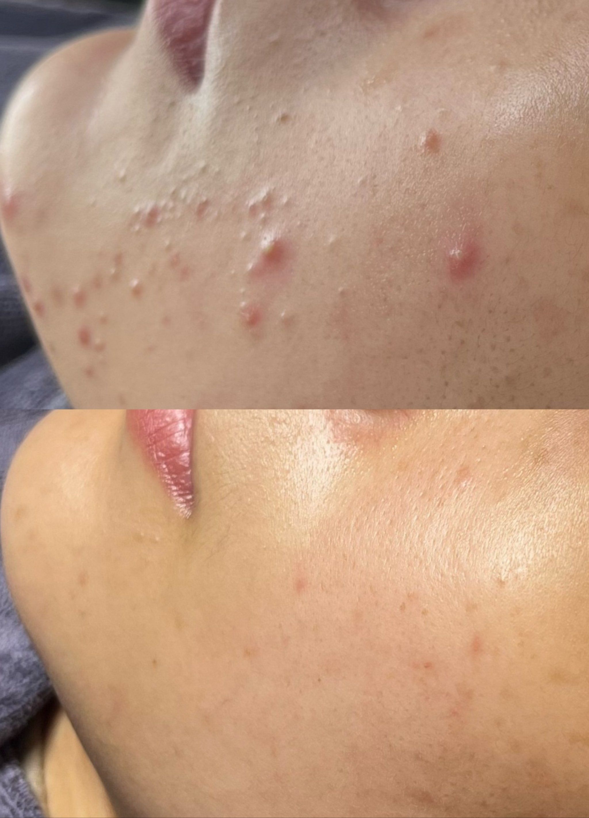 拜拜,烦恼的痘痘敌人