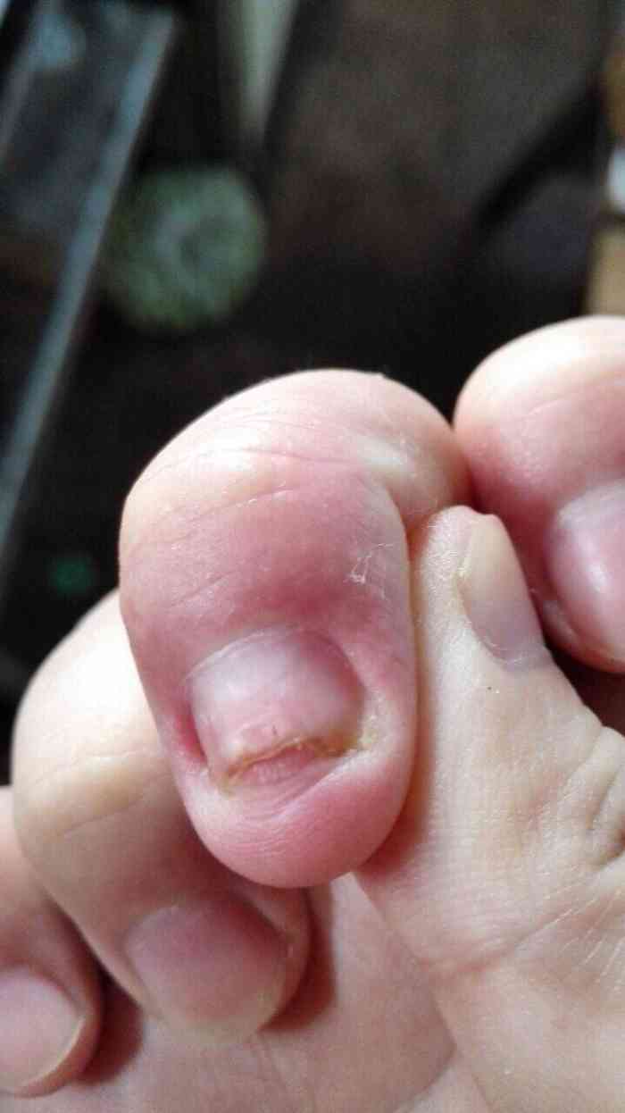 瀚博灰指甲-"觉得自己的大拇指脚指甲,像灰指甲,变的厚.