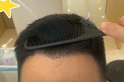 -大麦微针植发丨全国连锁