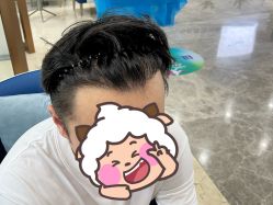 -大麦微针植发全国连锁