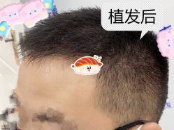 -大麦微针植发全国连锁