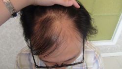 -大麦微针植发丨全国连锁