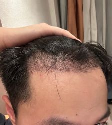 -大麦微针植发全国连锁