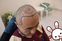 点击看大图 -大麦微针植发丨全国连锁