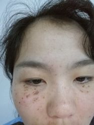 -美丽人生祛斑扁平疣汗管瘤中心