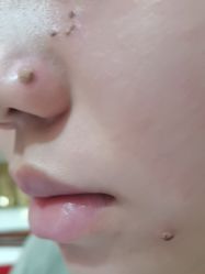 -北京美痣堂古方祛痣斑疣瘊