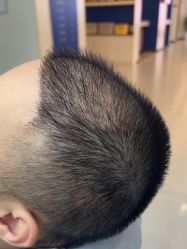 -大麦微针植发全国连锁