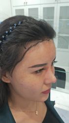 -大麦微针植发丨全国连锁