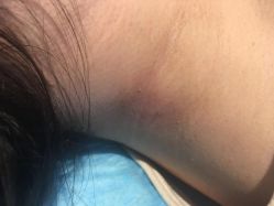 -美丽人生祛斑扁平疣汗管瘤中心