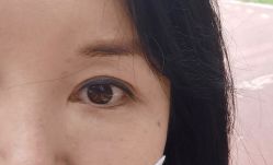 体验前-郑州米兰柏羽集美医疗美容医院