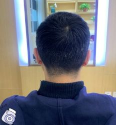 -大麦微针植发丨全国连锁