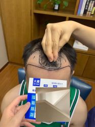 -大麦微针植发全国连锁