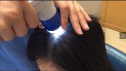 -大麦微针植发丨全国连锁