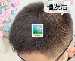 -大麦微针植发全国连锁