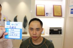 -大麦微针植发丨全国连锁