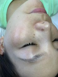 体验前-清疣美疣·痣·斑净肤中心