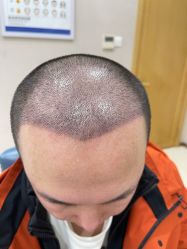 -大麦微针植发丨全国连锁