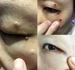 体验后-北京美痣堂古方祛痣斑疣瘊