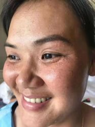 -美丽人生祛斑扁平疣汗管瘤中心