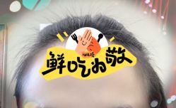 -大麦微针植发全国连锁