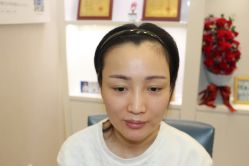 -大麦微针植发丨全国连锁