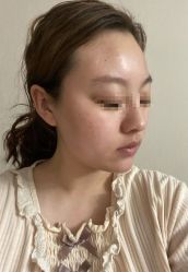 体验前-成都军建医院·疤痕诊疗中心