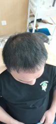 -大麦微针植发丨全国连锁