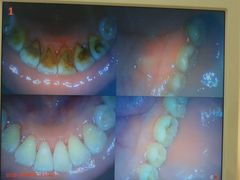 -赫尔森口腔·牙齿种植修复