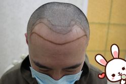 点击看大图 -大麦微针植发丨全国连锁