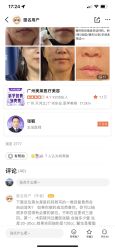 点击看大图 体验后-广州美莱医疗美容医院