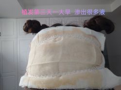 体验后-大麦微针植发丨全国连锁