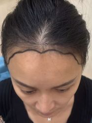 -碧莲盛·不剃发植发