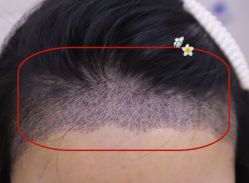 -大麦微针植发全国连锁