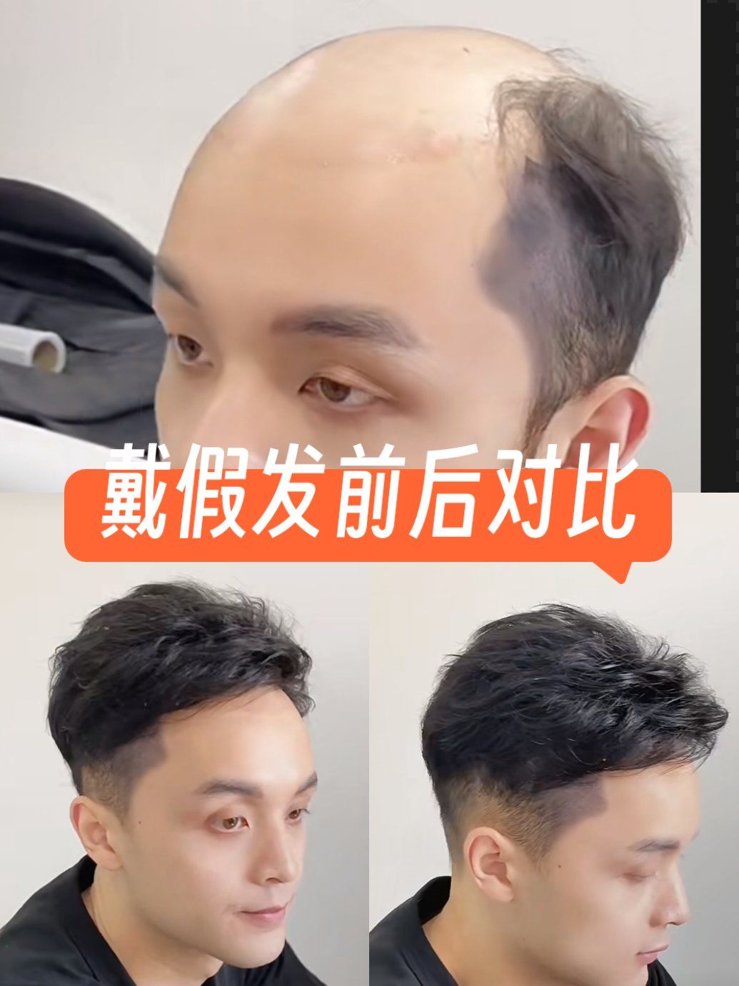 戴假发好 还是植发 权威对比相关图片5
