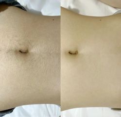 -薇兰专业脱毛连锁机构