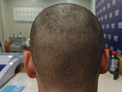 -碧莲盛·不剃发植发