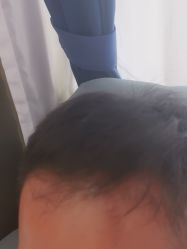 -碧莲盛·不剃发植发