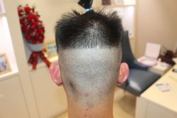 -大麦微针植发丨全国连锁