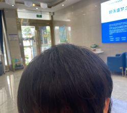 -碧莲盛·不剃发植发