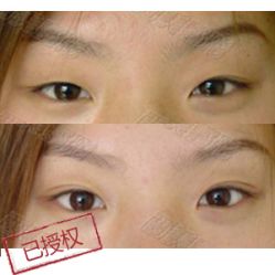 双眼皮效果图-西美医疗美容门诊部