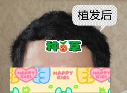 -大麦微针植发全国连锁