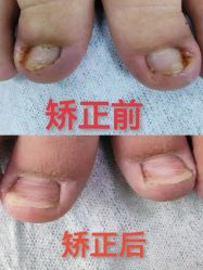 -德哥灰指甲脚气甲沟炎跖疣护理
