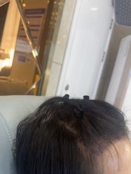 -碧莲盛·不剃发植发