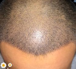 -大麦微针植发丨全国连锁