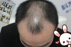 点击看大图 -大麦微针植发丨全国连锁