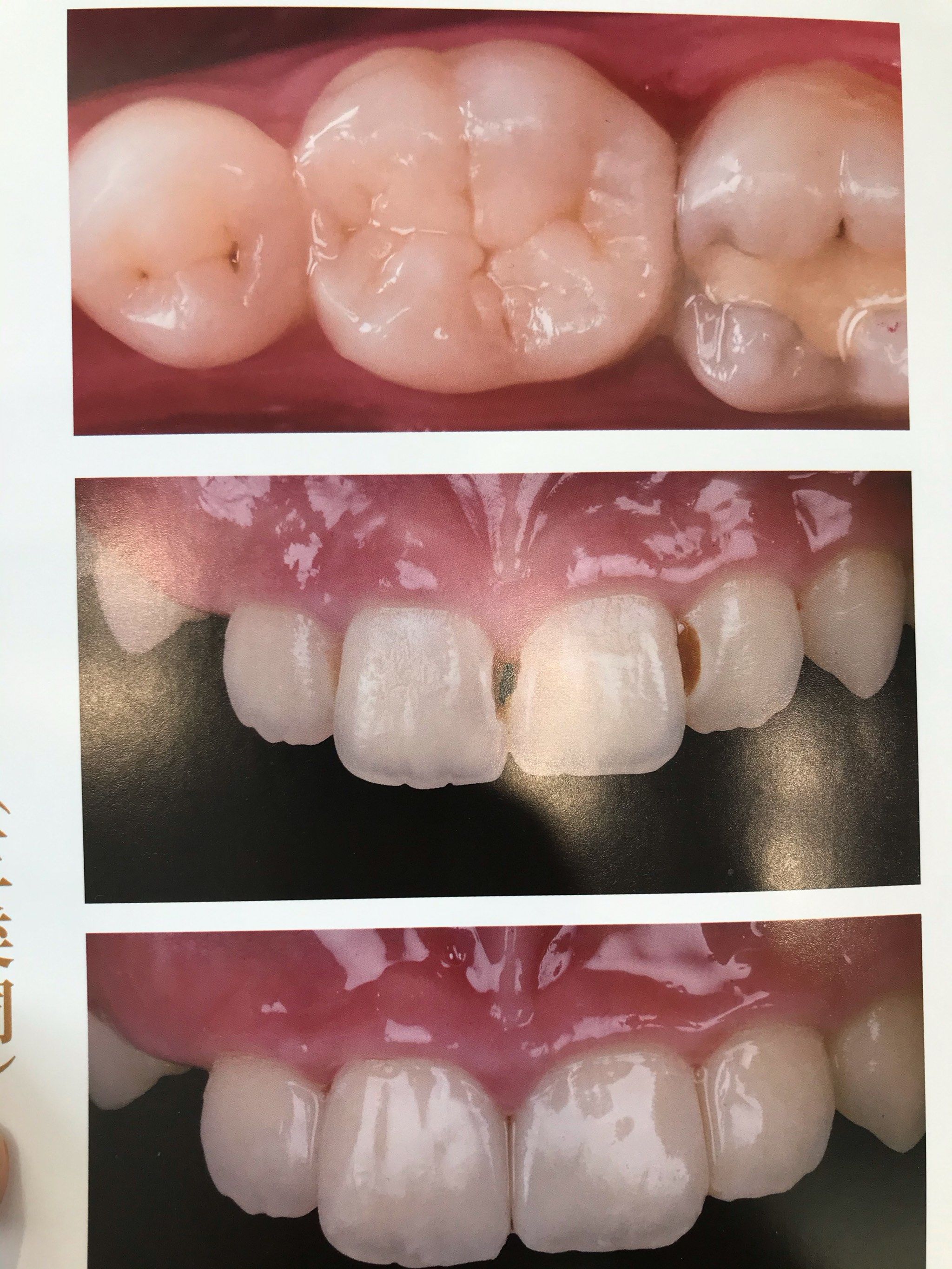 美塑树脂修复方案