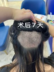 -大麦微针植发全国连锁