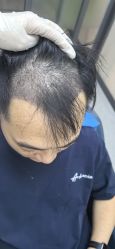 -大麦微针植发全国连锁